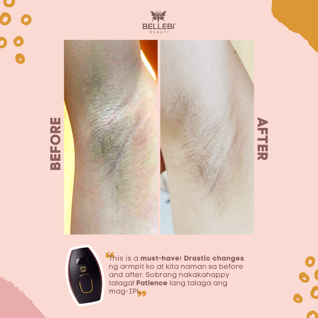 This is a must have! Drastic changes ng armpit ko at kita naman sa before and after using Bellebi Beauty IPL.